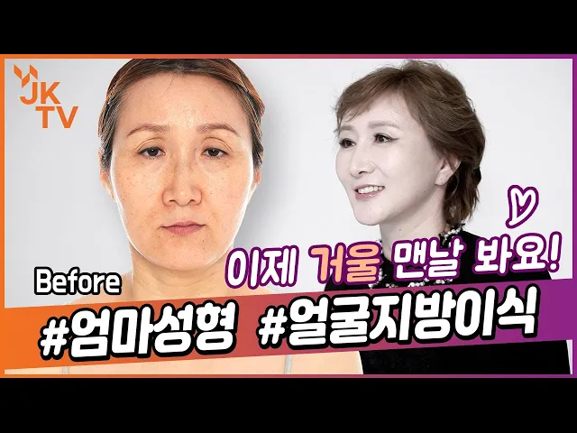 💜중년성형💜 풀페이스지방이식과 리프팅을 한번에 👀