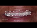 Porcelain Veneer Design (Digital Technique - Part II)