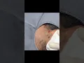 Download Lagu An Ear Cyst You Don't Want to Miss!