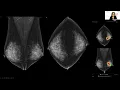 AI in Breast Imaging An Asian Perspective