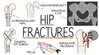 Download Understanding Hip Fractures and Hip Surgery MP3