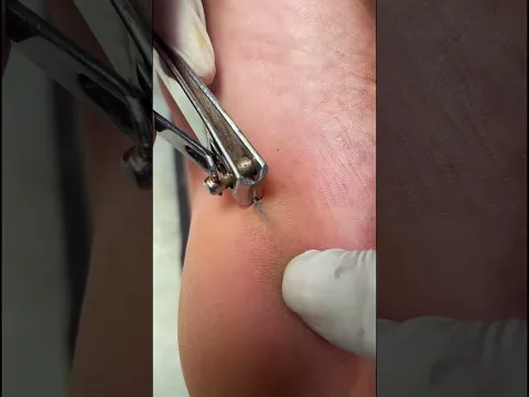 Thorn Removal #removal
