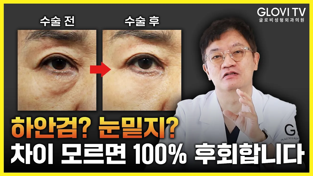 눈밑지방재배치와 하안검👀 딱 이렇게 고르세요✔