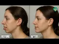 Overbite Transformation What Actually Works How to Fix an Overbite