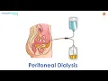 What is Peritoneal dialysis l Manipal Hospitals Bengaluru
