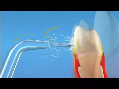 Video thumbnail: How a water flosser cleans around bridges and implants (animation)