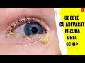 Download Lagu Ce este cu adevarat mizeria de la ochi?