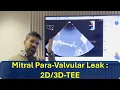 Lagu Mitral Para-Valvular Leak, 2D/3D-TEE (Simulator-Based) live demonstration