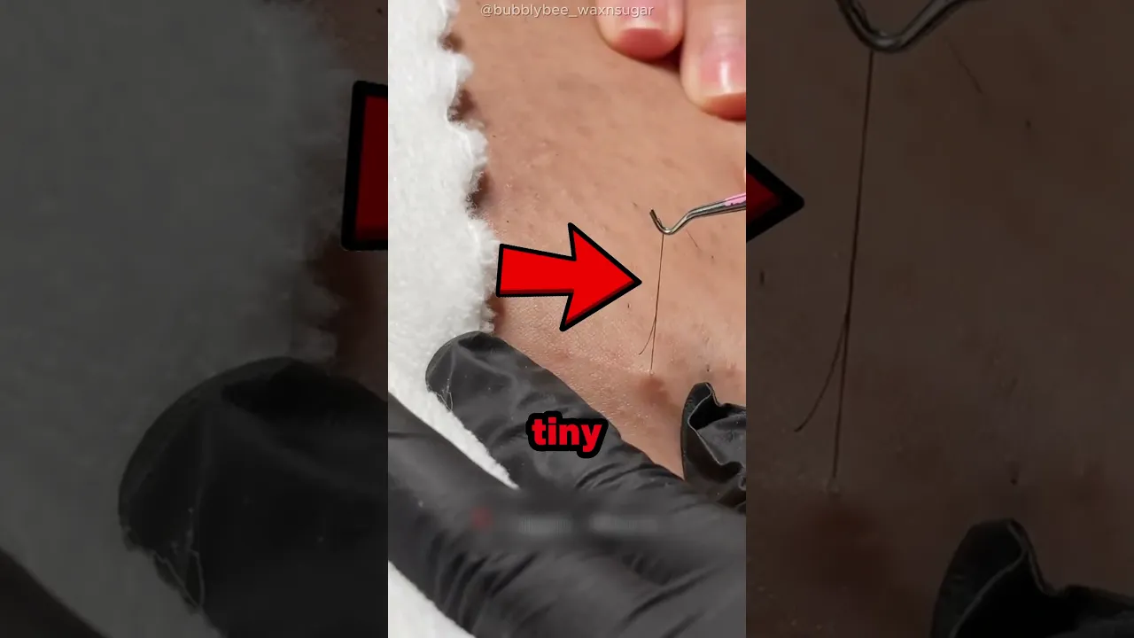 Big Ingrown Hair 😲