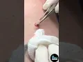 Download Lagu A Hard Pops Medley by Dr. Pimple Popper