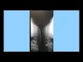 Barium Swallow Study for Dysphagia Evaluation