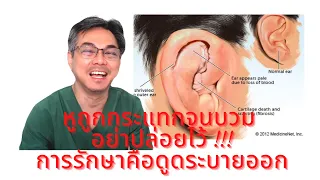  กระดูกอ่อนใบหูอักเสบ เกิดจากสาเหตุอะไร และมีผลอย่างไรถ้าไม่รักษา 