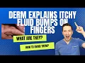 Do you have ITCHY FLUID LITTLE BUMPS on your HANDS OR FEET Derm explains Dyshidrotic Eczema