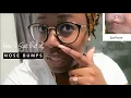 HOW TO GET RID OF A NOSE PIERCING BUMP KELOID FAST hellotinashe