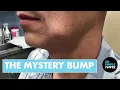 We Didn t Know What This Cheek Bump Was Until We Took It Out