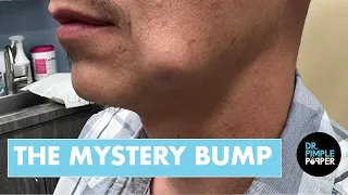 We Didn t Know What This Cheek Bump Was Until We Took It Out