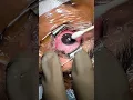 Download Lagu EPI Contoura Eye Treatment!!! #eye #eyehospital #eyesurgery #contoura #epicontoura #contourasurgery