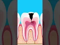 Download Lagu What happens if tooth decay is left untreated