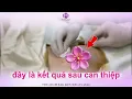 Download Lagu Bác sĩ ơi! Hút u vú bằng VABB có thật sự không để lại sẹo như lời đồn??
