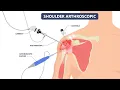 Arthroscopic shoulder surgery CPT codes - simplify medical coding