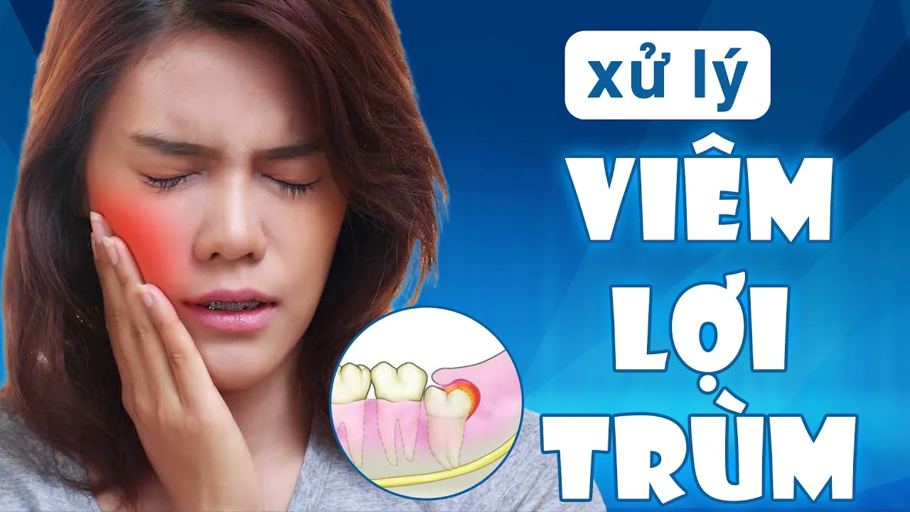 Outline Video Viêm lợi trùm là gì ? | Cách xử lí viêm lợi trùm như thế nào?