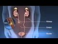 Download Lagu Ureteroscopy (URS)
