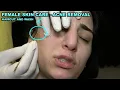 Download Lagu ASMR FEMALE SKIN ACNE REMOVAL AND CARE + HAIRCUT + HAIR CARE + HAIR WASH +  DEEP SLEEP FOR YOU