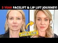 59 Year Old s 2 Year Facelift and Lip Lift Journey her entire post-op recovery