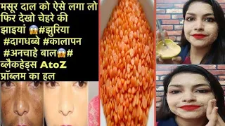 कितनी भी पुरानी झाइयां, Pigmentation जड़ से खत्म करें 100% रिजल्ट || How To Remove Pigmentation