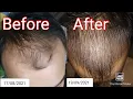 Download Lagu minoxidil 5 % and Derma roller results in 2 months
