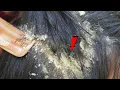Download Lagu Dandruff Shampoo and Scratching, Itchy Dry Scalp, Huge Flake   Psoriasis #55