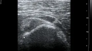 Ischial bursa injection