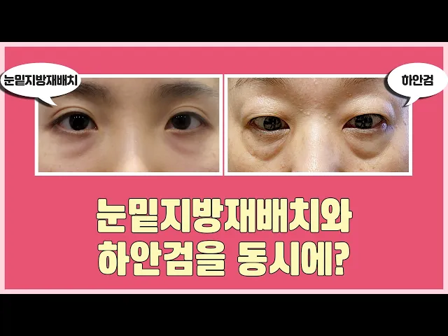 눈밑지방재배치 할 때 하안검도 같이 할 수 있나요?