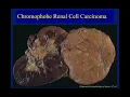 Classification and Diagnostic Approach to Oncocytic Renal Tumors by Dr Eman Abdulfatah