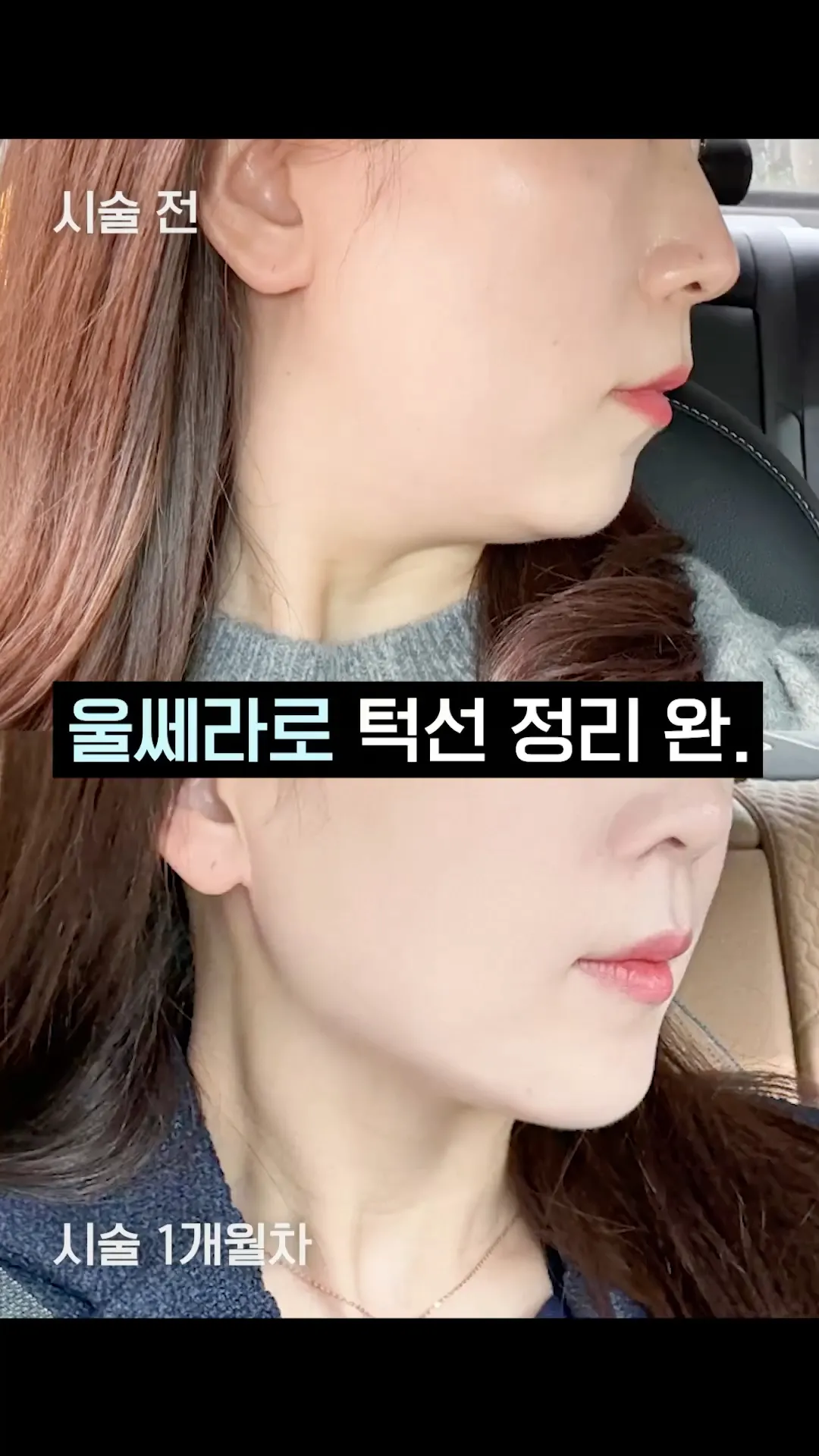 울쎄라피 프라임 시술 과정 영상 썸네일