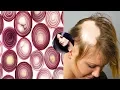 Download Grandma's SECRET Recipe for Hair growth in 15 days Onion Juice And Coconut Oil Pack treatment mp4 3gp mp3 videos - waplic