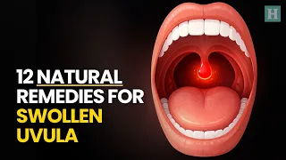 12 Natural Remedies For Swollen Uvula Healthspectra