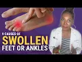 Download Lagu Foot and Ankle Swelling: 9 Dangerous Causes You Should NEVER Ignore!