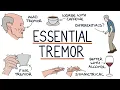 Download Lagu Inzicht in goedaardige essentiële tremor