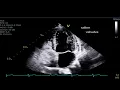 Negative Saline Bubble Study