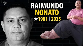 DIÁRIO DOS M0RTOS - Nonato, HOMEM que PRECISOU REM0VER a PERNA após ser INFECTADO por um MOSQUITO