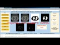 Lung Nodule Detection On Dicom Image Using Neural Network With Source Code Matlab Project Code