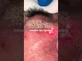 Download Lagu Non-Surgical Facelift? See Laser Skin Tightening in Action!  #skincare  #beautydoc  #laserskincare