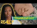 Download Lagu Dr. Ebonie Performs Surgery On Severely Deformed “Frankenfoot” | My Feet Are Killing Me