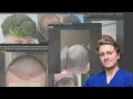 Hair Doctor reacts to Reddit Hair Loss Nightmares