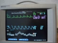 Download Lagu HP Viridia -ecg/resp, spo2 Alarms