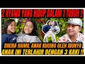 Download Lagu VIRAL MUKJIZAT TUHAN‼️ TERLAHIR KEMBAR SIAM DEWI DAN PUTRI TIDAK MAU DI PISAHKAN⁉️