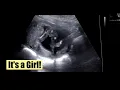 Ultrasound of 16 Weeks Pregnancy Baby Girl