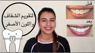 كيف تحافظ على نظافة التقويم الشفاف خلطة للتخلص من صفار التقويم  كيف تحافظ على نظافة التقويم الشفاف خلطة للتخلص من صفار التقويم