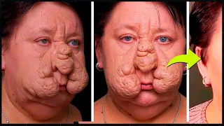 Lembra da MULHER que ficou DEF0RMADA por 'CUTUCAR' o ROST0? Ela se RECUPEROU após PROCEDIMENT0S!
